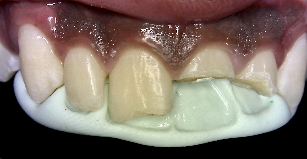 Root canal and restoration planning